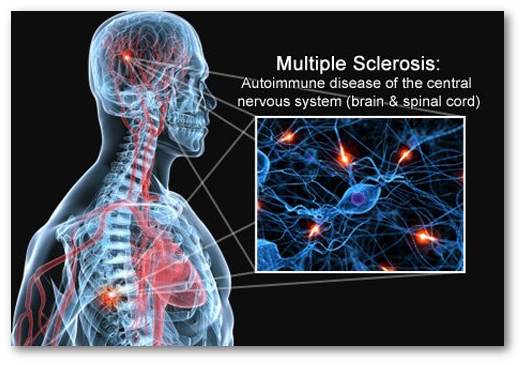 multiple-sclerosis-s1-brain-spinal-cord-nerves