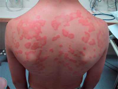 hives_on_back